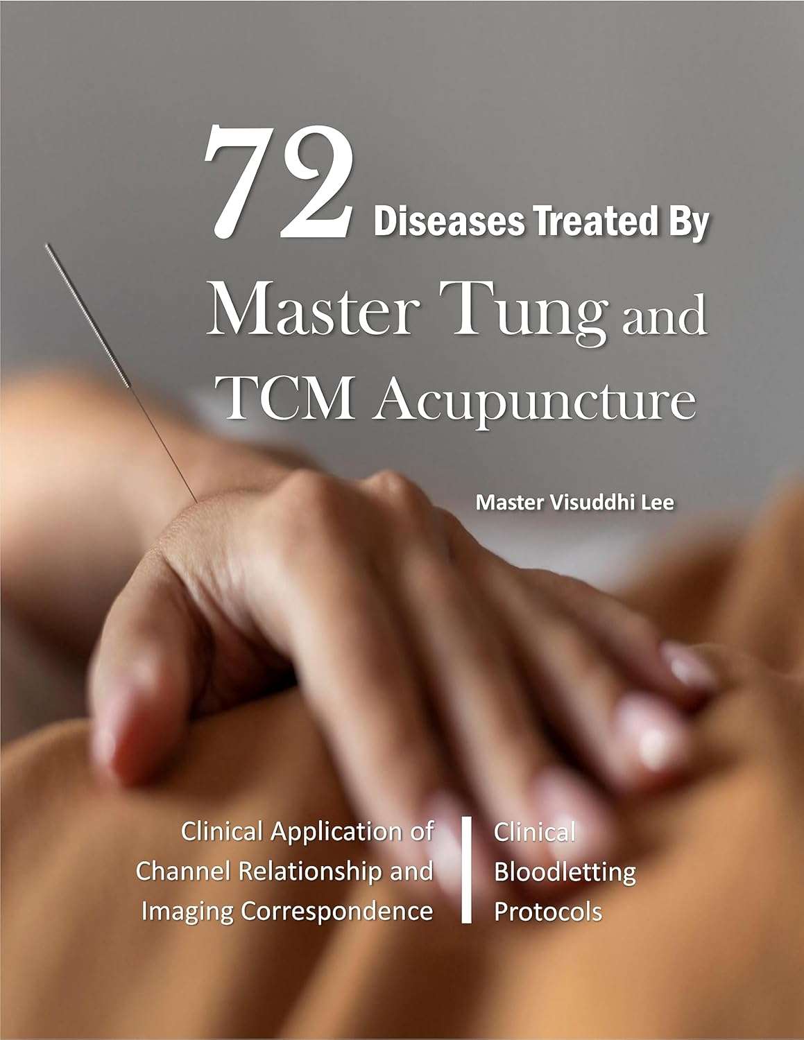  72 Diseases Treated by Master Tung and TCM Acupunc (Master Tung and TCM Acupuncture: Points and Treatments (Volume 2):)